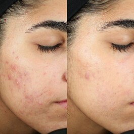 Blemish Control Invisiscar Treatment - Léčba jizev po akné