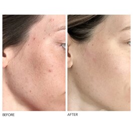 Alpha Beta® - Každodenní peeling s univerzálním složením