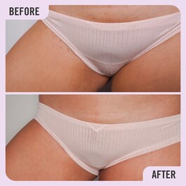 Ingrown Hair Pads - Tamponky na ošetření zarostlých chloupků