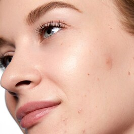 Acne Day Dot – Náplasti proti nedokonalostem