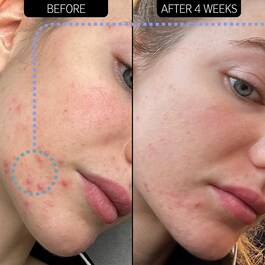 Blemish Clearing Moisturizer 2% NovoRetin - Hydratační noční krém