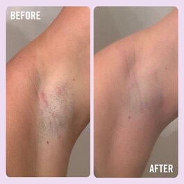 Ingrown Hair Pads - Tamponky na ošetření zarostlých chloupků