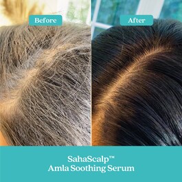 SahaScalp™ Reset Kit - Sada pro péči o pokožku hlavy