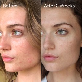 Blemish Control Invisiscar Treatment - Léčba jizev po akné