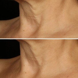Smart Clinical Repair™ - Liftingový krém na obličej a krk