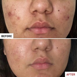 Centella Acne Care - Zklidňující péče